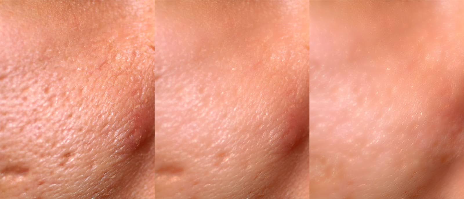 Types of Lasers Skin Treatments: Ablative vs Non-Ablative