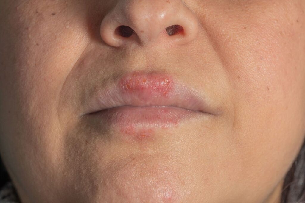 Essential Guide to Botox Side Effects: Risks and Realities
