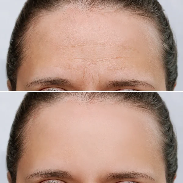 Botox Cosmetic before and after results Botox Cosmetic before and after results